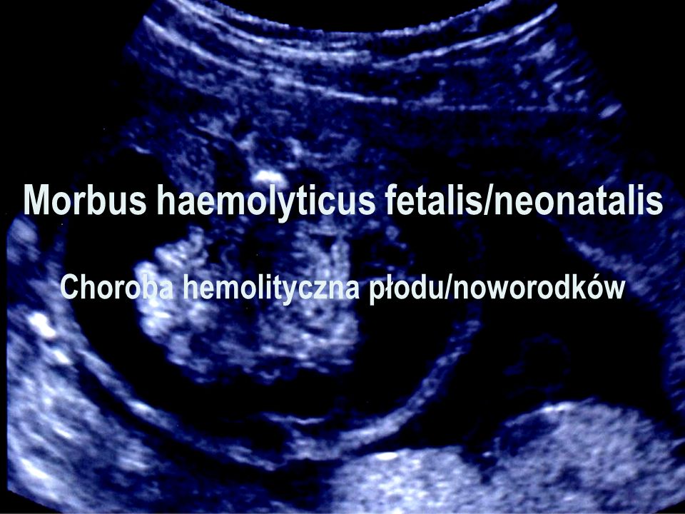 Morbus haemolyticus fetalis/neonatalis Choroba hemolityczna płodu/noworodków