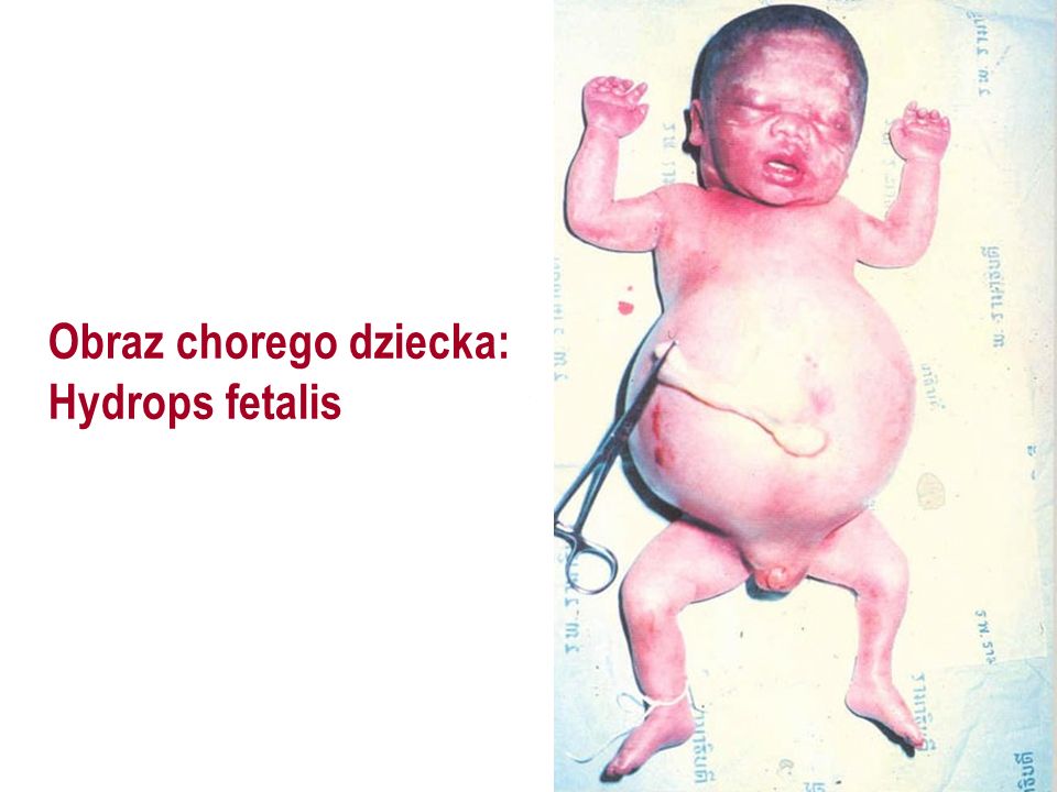 Obraz chorego dziecka: Hydrops fetalis
