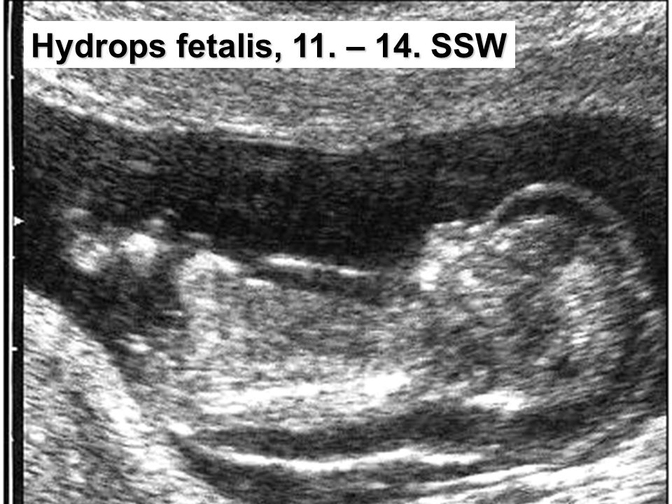 Hydrops fetalis, 11. – 14. SSW