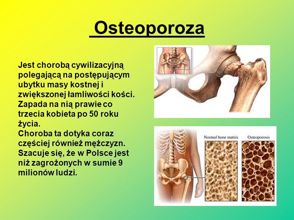 Osteoporoza t Jest chorobą cywilizacyjną polegającą na postępującym ubytku masy kostnej i zwiększonej łamliwości kości.
