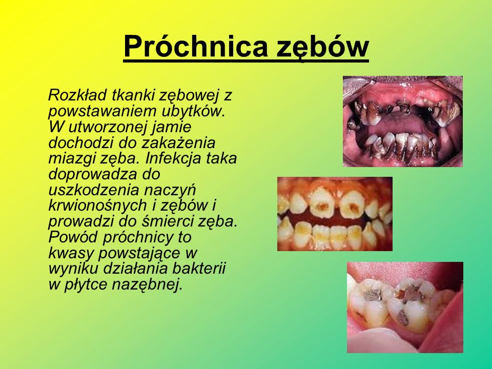 Próchnica zębów Rozkład tkanki zębowej z powstawaniem ubytków.